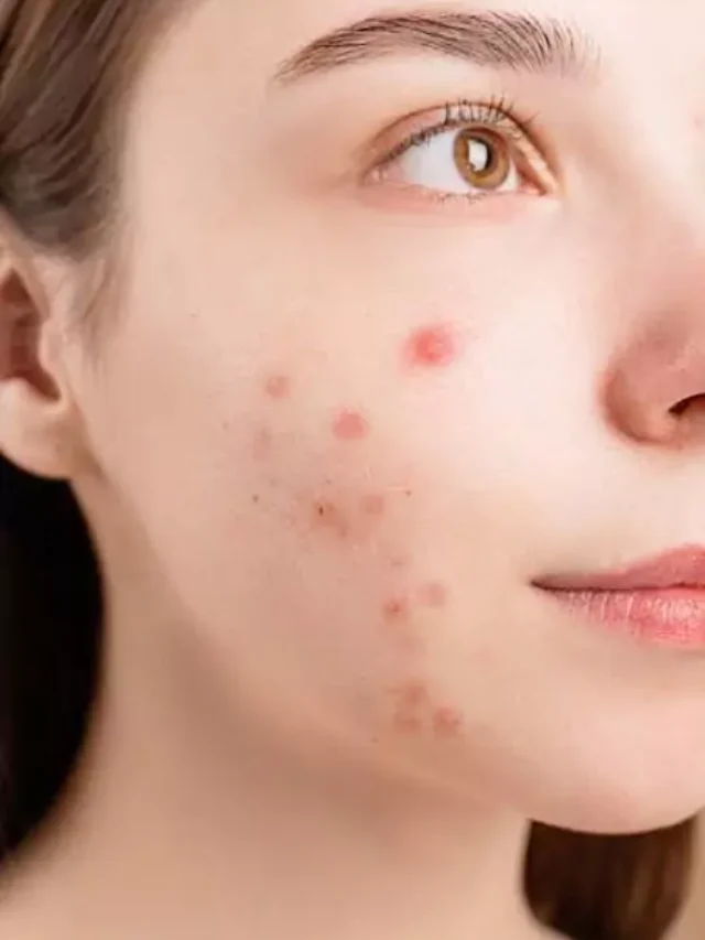 Best home remedies for pimples