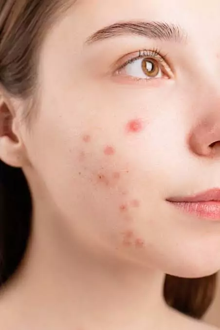 Best home remedies for pimples