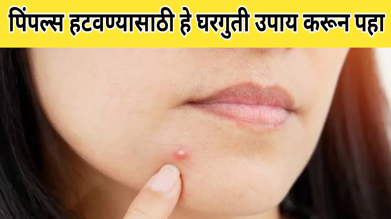 Remedies For Pimples On Face